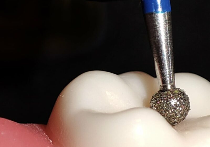 Finitions impeccables : les fraises flamme, un incontournable en dentisterie